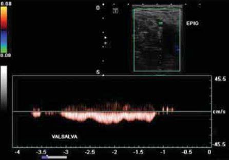 Az áramlásfokozás hatására a Doppler-jel a jól észlelhető tartományba kerül. Az áramlás létrejötte, vagy hiánya, ill. annak irányultsága fontos információt ad.