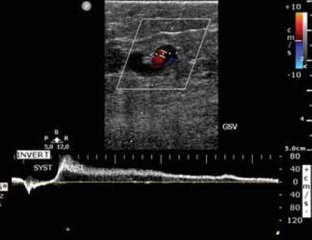 7. ábra. Jelentős reflux a v. saphena magnában, Paraná-manőver során. Az elhúzódó reflux oka feltehetően, a felnyomott vérmennyiség visszafolyása által megindított szifon hatás.