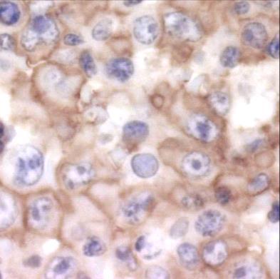 A lymphoid rendszer betegségei DLBCL Diffúz nagy B-sejtes lymphoma Leggyakoribb