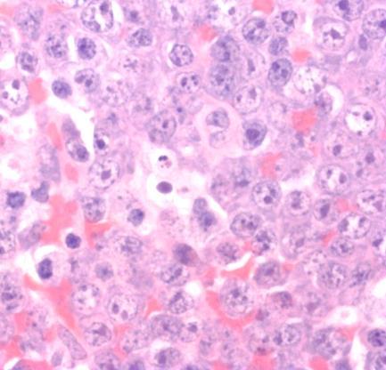 Centroblast Immunoblast Nodalis és extranodalis formái is gyakoriak Gyomor-bél