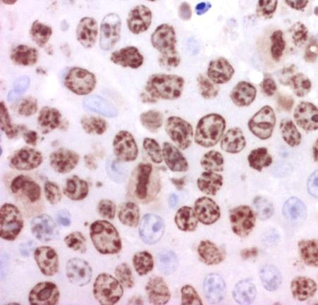 alacsony malignitású B-sejtes lymphoma transzformációjaként is keletkezhet High