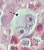 fibroblastokból reticulumsejtekből álló