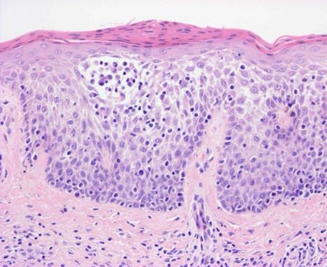 Epidermotropismus SS: