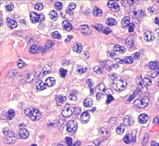 A lymphoid rendszer betegségei Lymphoma Angioimmunoblastos T-sejtes lymphoma