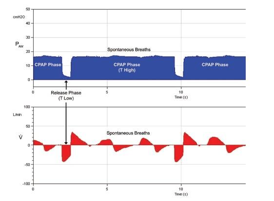 APRV - APRV Airway Pressure Release Ventilation ua,