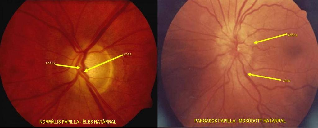 KONTRAINDIKÁCIÓ: intracraniális