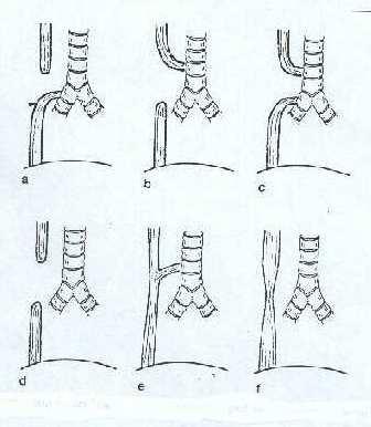 Oesophagus atresia Túlélés 1955-61 kb.