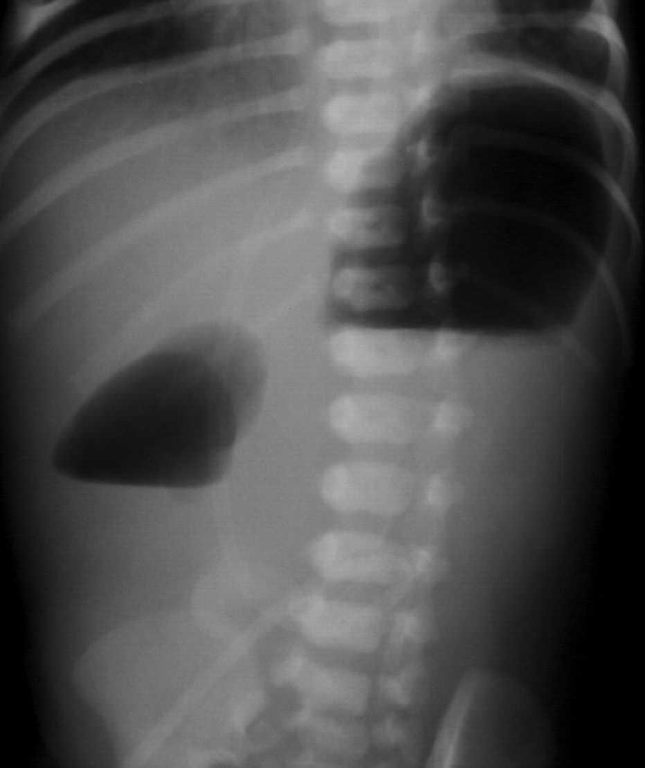 Duodenum atresia Praenatalis diagnosztika Genetikai