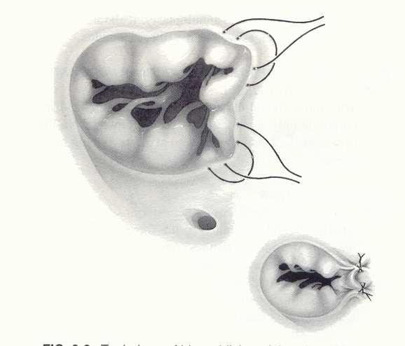 Tricuspidális billentyű betegségei Tricuspidalis billentyű