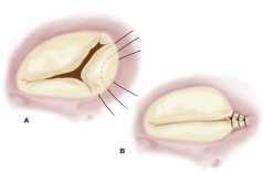 s disease Annulus plicatio- Bicuspidalizácio Bicuspidalizáció a