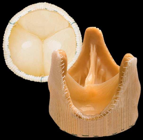 Stentless Bioprosthesis Korlátozott