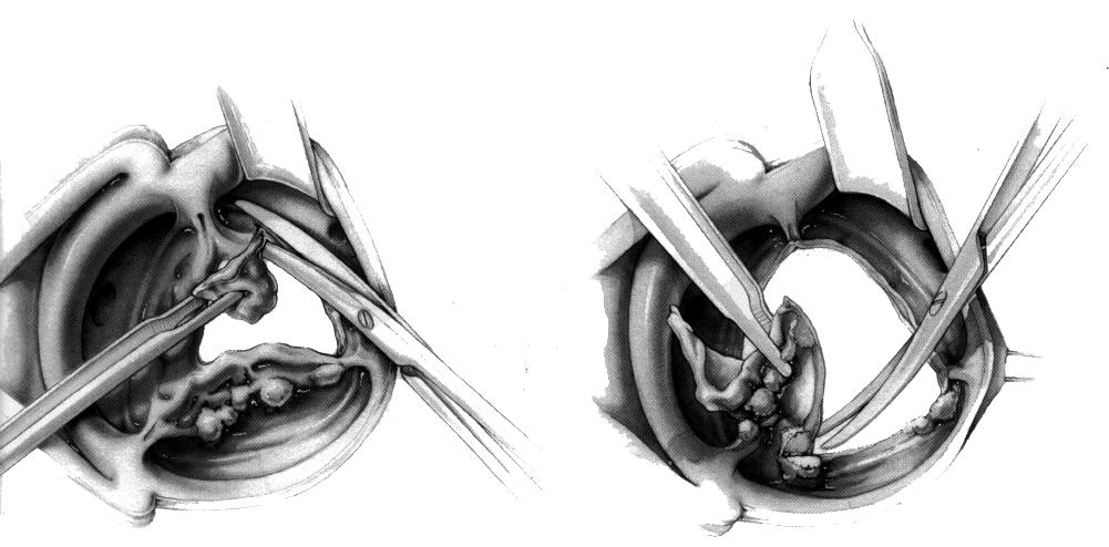 Aorta