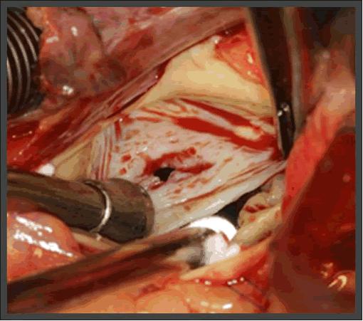 aorta 