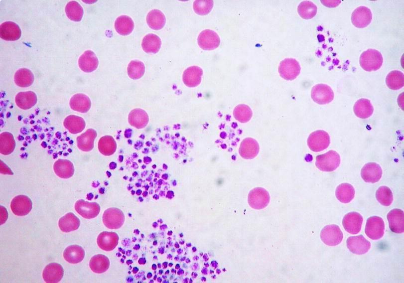 EDTA indukálta pseudothrombocytopenia Az összes vérkép vizsgálatok 0.07-0.11%-ban. Többnyire EDTA-val antikoagulált vérben.