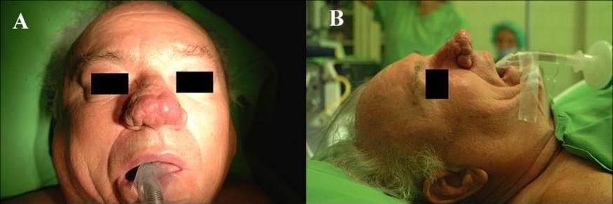 A rinofíma (6. ábra) esztétikailag zavaró elváltozás: a külső orr krónikus betegsége, az acne rosacea végső stádiumának tekintendő (Rohrich és mtsai, 2002).