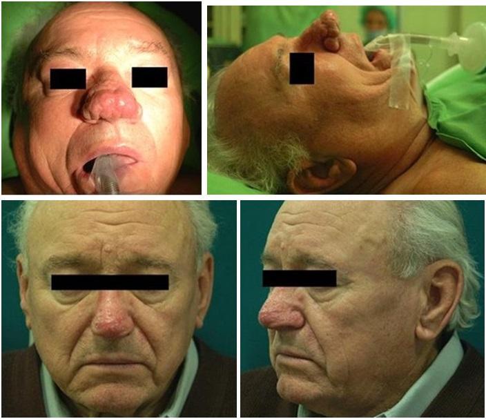 A műtéti idő átlagosan 45 perc volt, a műtéti terület relatíve vérmentesnek bizonyult. A keletkező füst mennyisége nem volt zavaró, a hagyományos szívó elegendő volt.