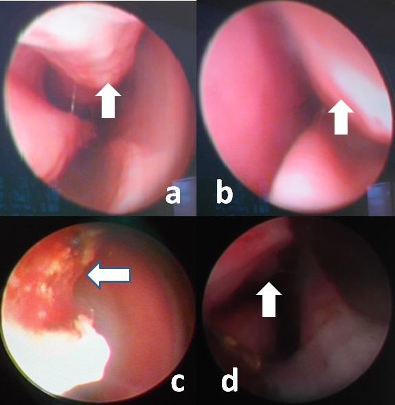 (d) Nd:YAG-lézer csoport (nyíl: vastag fibrin az alsó orrkagyló mentén. B. a 6.