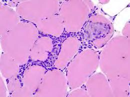 Idiopathiás inflammatorikus myopathiák Myositis Heterogén, több szervrendszert érintő betegségcsoport Krónikus progresszív szimmetrikus proximális izomgyengeség Karakterisztikus bőrtünetek