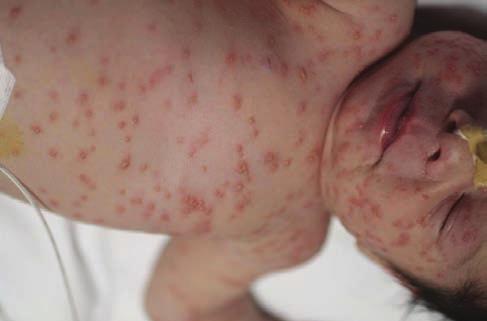 A sebaceus mirigyek hyperplasiáját az in utero androgén stimuláció eredményezi, a tünetek néhány hét alatt spontán regrediálnak.