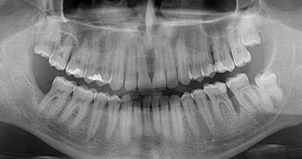 Orthopantomogram
