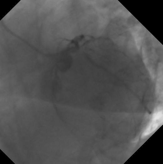 dohányzás 3 hónappal korábban instabil angina pectoris miatt RCA PCI (Xience V