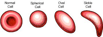 B./ Haemolysis (vvs membránok destructioja) Congenitalis (enzym defectus) spherocytosis