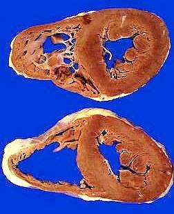 Cor pulmonale: Pulmonalis hypertonia következtében kialakult jobb kamra hypertrophia és/vagy dilatatio (a balszívfél-eredet, a billentyű-eredet, szívfejlődési rendellenességek kizárva!!) 1.