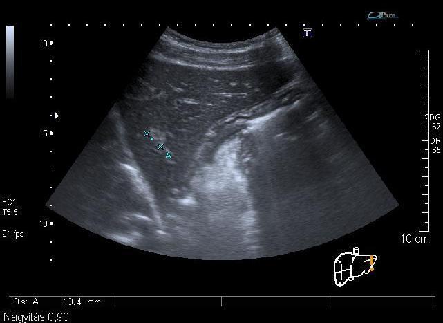 Nem ritka, hogy többféle típusú elváltozás együtt is előfordul (FNH és haemangioma, ciszta stb.). A haemangiomák és a malignus folyamatok közötti differenciálás sokszor okoz gondot.