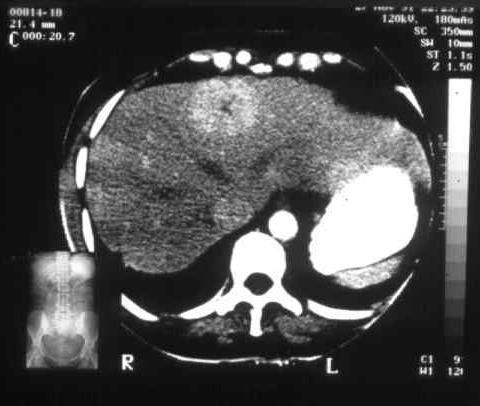 7. táblázat: Tumor/ máj festődés aránya Korai Artériás Késői Artériás Parenchymás fázis 15 sec 30sec 105sec FNH HCC, hipervaszkularizált metasztázis HCC, hipervaszkularizált metasztázis Szükség van