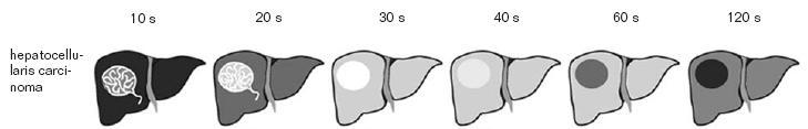 4.2. Primer májrák A HCC rendkívül sokarcú tumor; a carcinogenezis, a megjelenés és a radiológiai kép igen variábilis.