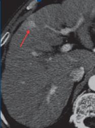 Ultrahang-vizsgálat: általában echószegény, inhomogén, szolid, AV shunt lehet, vena portae trombózis gyakori, ez color-doppler vizsgálattal jól látszik.