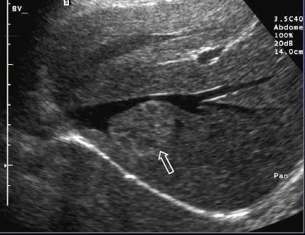 4.5. Hepatocelluláris adenoma Ultrahang-vizsgálat: a májsejtadenoma többféle echostruktúrát mutathatnak, általában azonban a környező parenchymához képest kissé echoszegényebbek, szerkezetük