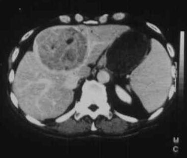 2D- B-mód CT-vizsgálat: a májadenoma általában nagyobb tumorként látható (3-4 cm felett), a gyakori nekrózis és vérzés inhomogénné teszi a belső szerkezetét.