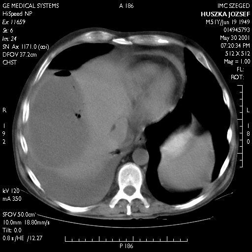 ABSCESSUS