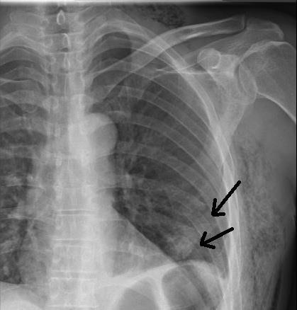 Diagnosztikája: Mint minden traumás beteg esetén az elsődleges vizsgáló módszer a fizikális, melynek menete a következő: 1.