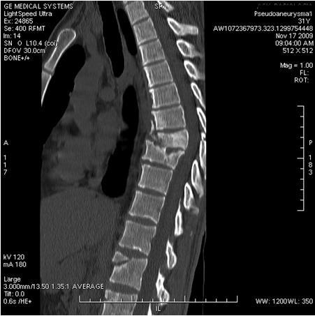 Lehetséges szövődmények: Chylothorax, és sero-haemothorax alakulhat ki a műtét következtében illetve sérülhetnek a lokális lágyrészek, a rögzítő csavarok kilazulhatnak és megsérthetik a környező