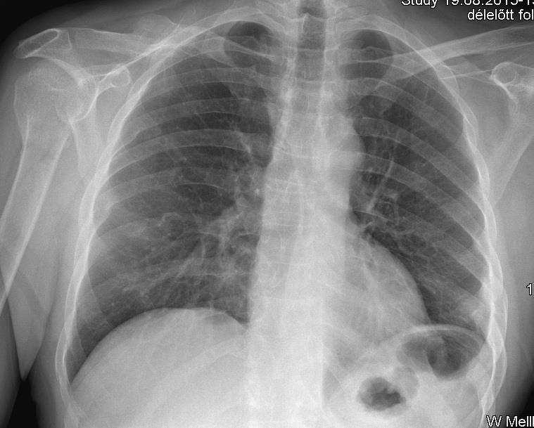 5. kép Mellkas röntgen felvétel: mindkét oldali csúcsi pneumothorax [19.] 2.5.2 Haemothorax Kórlefolyását tekintve azonos a pneumothoraxxal, sőt gyakran a kettő kombinálva: haemopneumothoraxként jelentkezik.