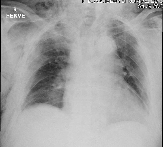 6. kép Mellkas röntgen felvétel: traumás haemothorax [20.] 2.5.3. Pleuralis folyadék gyülem Direkt nagy erő behatású mechanizmust követően jön létre, ilyen például egy nagy erejű frontális ütközés.