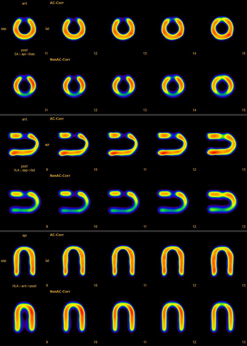 kamera Mediso AnyScan TM SPECT/CT kollimátor LEHR projekciós képek száma 128 projekciós képek mérete 128 128 pixelméret 4mm szkennelt szögtartomány 360 gyűjtési idő 20 másodperc / kép