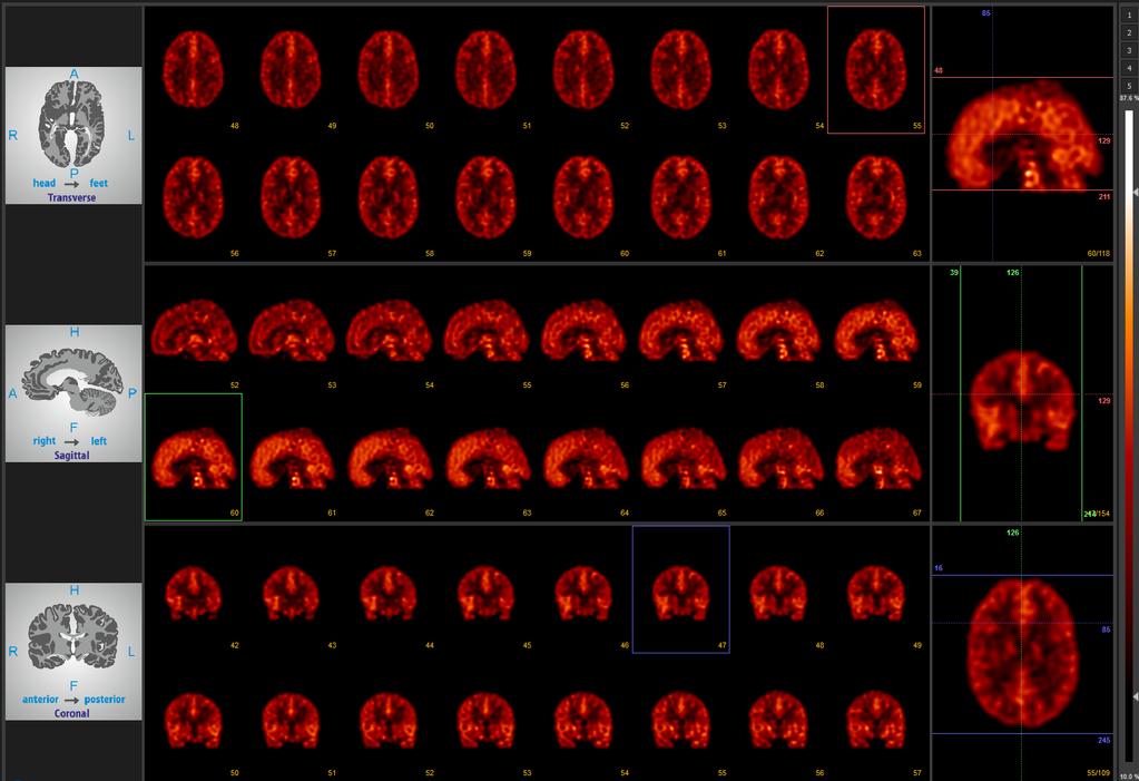 4.17. ábra. 3D agyfantom mérés Mediso Anyscan kamerával. A 3D-OSEM rekonstrukció során detektorválasz kompenzációt és elnyelési korrekciót végeztünk.