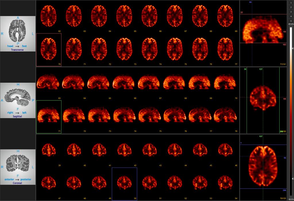 4.19. ábra. Mediso NanoSPECT kamerával készült 3D agyfantom mérés 3D-OSEM rekonstrukciója detektorválasz kompenzációval.