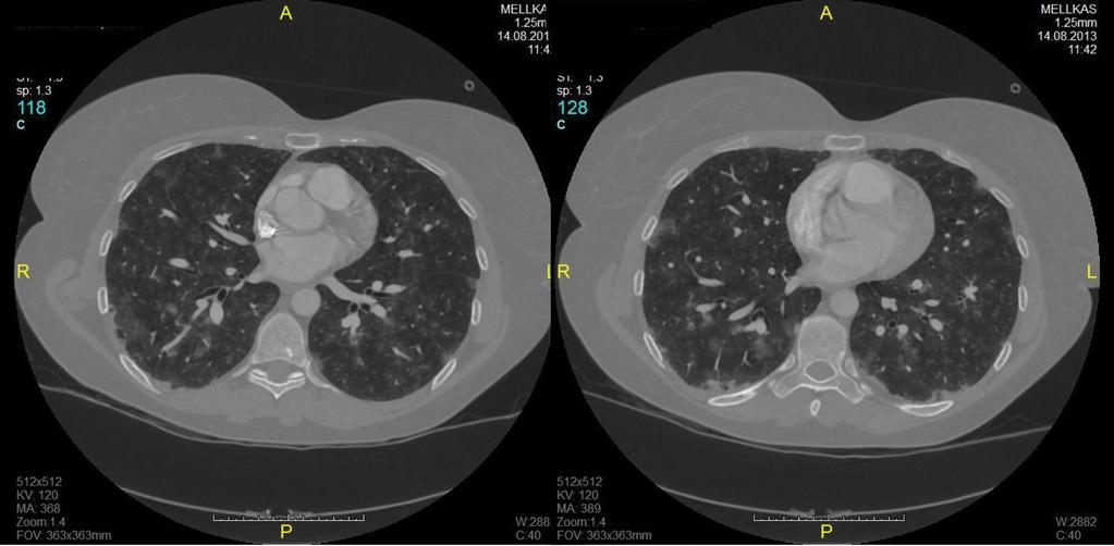 8. ábra Akut diffúz tüdőkárosodás (ARDS) képe, amely a fiatal HL-beteg kezelésének (6 COPP/ABV + mantle irradiáció) befejezése után 20 évvel annak következtében kialakult pulmonalis fibrosis és