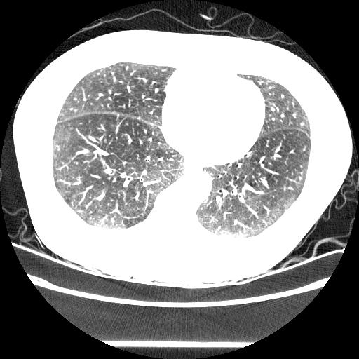 4.1. ábra. Egy szelet a CT-felvételből. hatékonyabb CAD (Computer-Aided Detection) rendszereket fedezzenek fel, amik automatikusan detektálják a rákos csomókat a tüdőben.