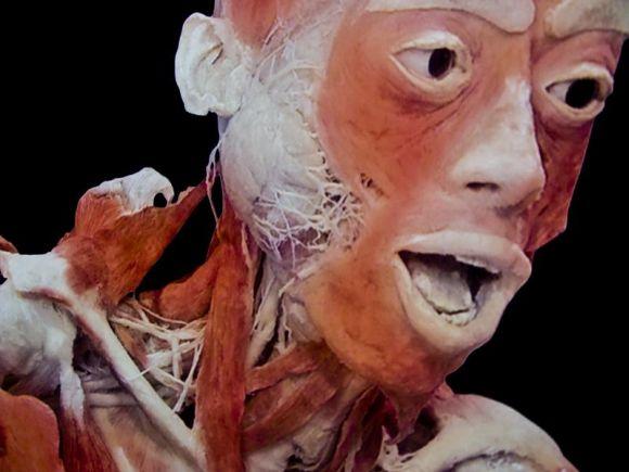 A tárlton üvegedényekben, trtókbn vlószínűsíthetően formlinbn tárolt kioperált tumor képletek