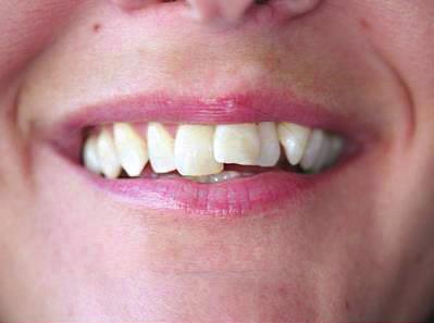 Hogyan működik a Happysmile láthatatlan fogszabályozó rendszer?
