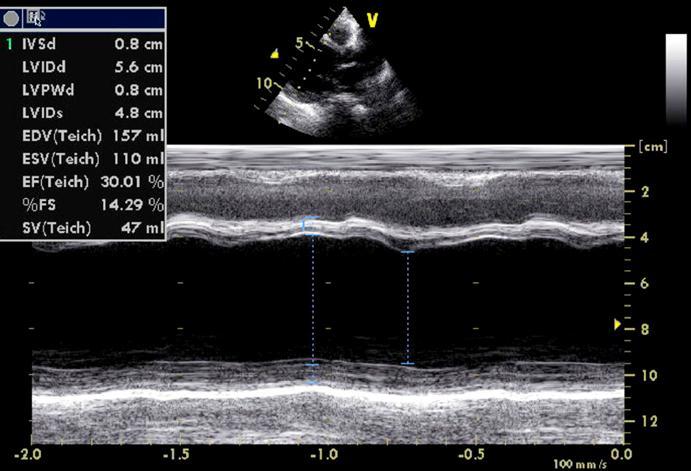 Kóros M-mód kép Dilatatív cardiomyopathia Gyenge septum-