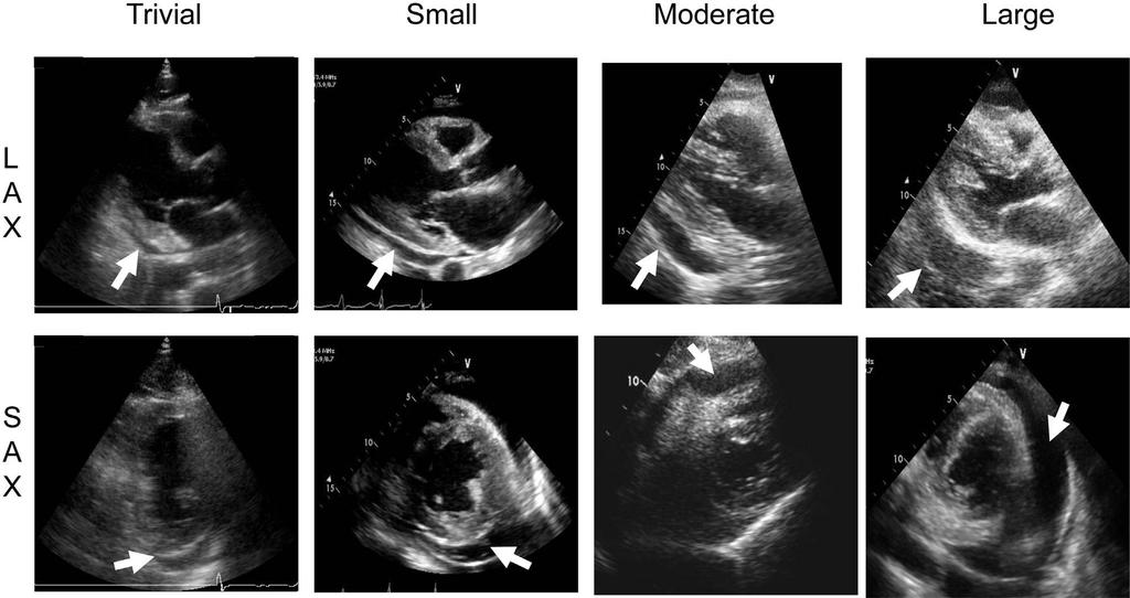 Pericardialis folyadékgyülem Fenyegető tamponád nem feltétlenül függ össze a pericardialis folyadék