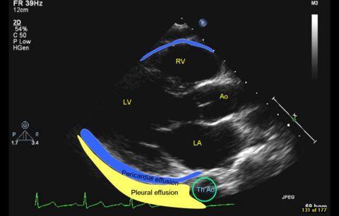 Pericardialis folyadékgyülem A