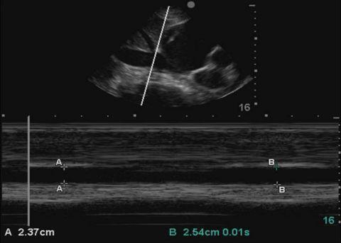 Pericardialis tamponád- VCI kaliber Dilatált vena