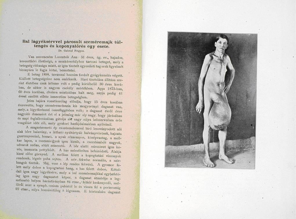 topoľčianskej nemocnice Alojz Fridrich (1859-?) 197 zhrnul svoje skúsenosti s liečbou hernie v nemocnici. Uviedol, ţe v r. 1886-1891, operovali šesť prípadov, z toho päť úspešne.